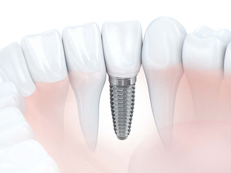 人工植牙