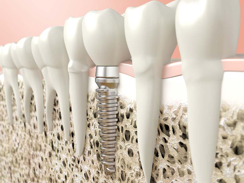 人工植牙